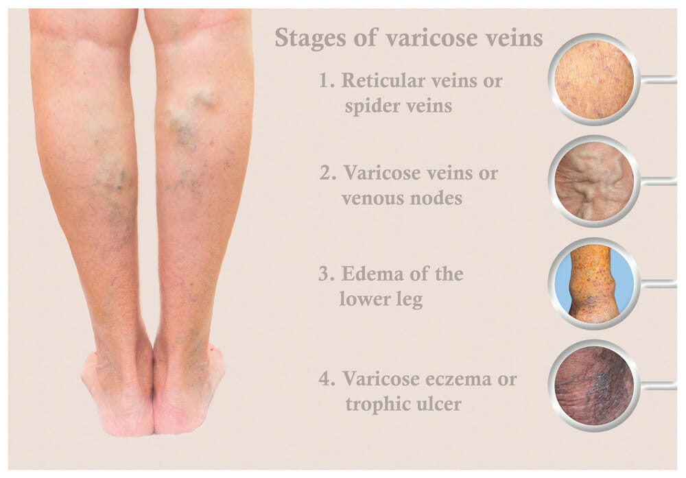 Varicose Veins: Everything You Need to Know