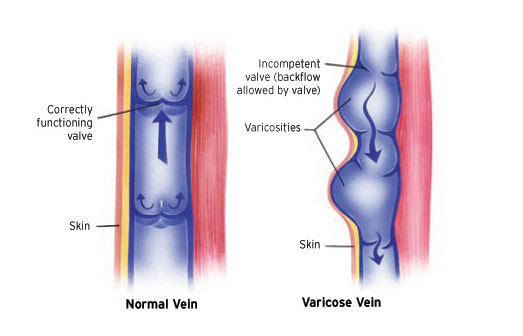Busted 5 Myths About Varicose Veins You Really Shouldnt Believe Midwest  Institute for NonSurgical Therapy Vascular and Interventional Radiologists