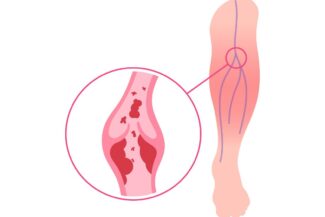 illustration of deep vein thrombosis